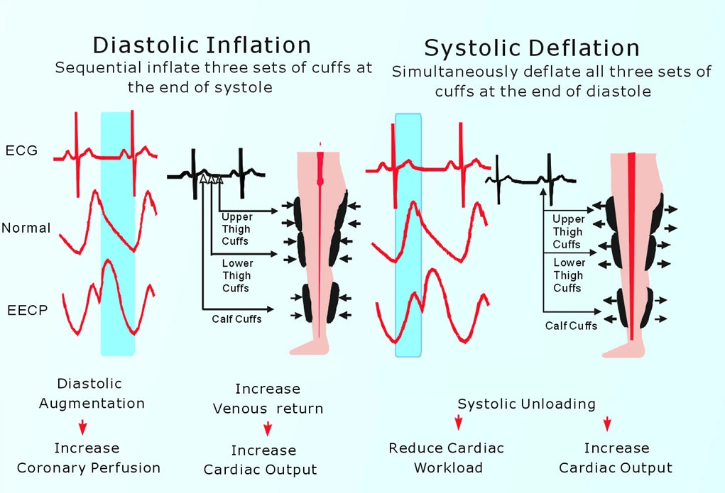 Non-Invasive Eecps Machine for Cardiac Rehabilitation with Automatic System